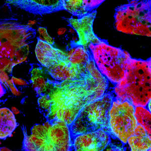 A picture of cancer cells